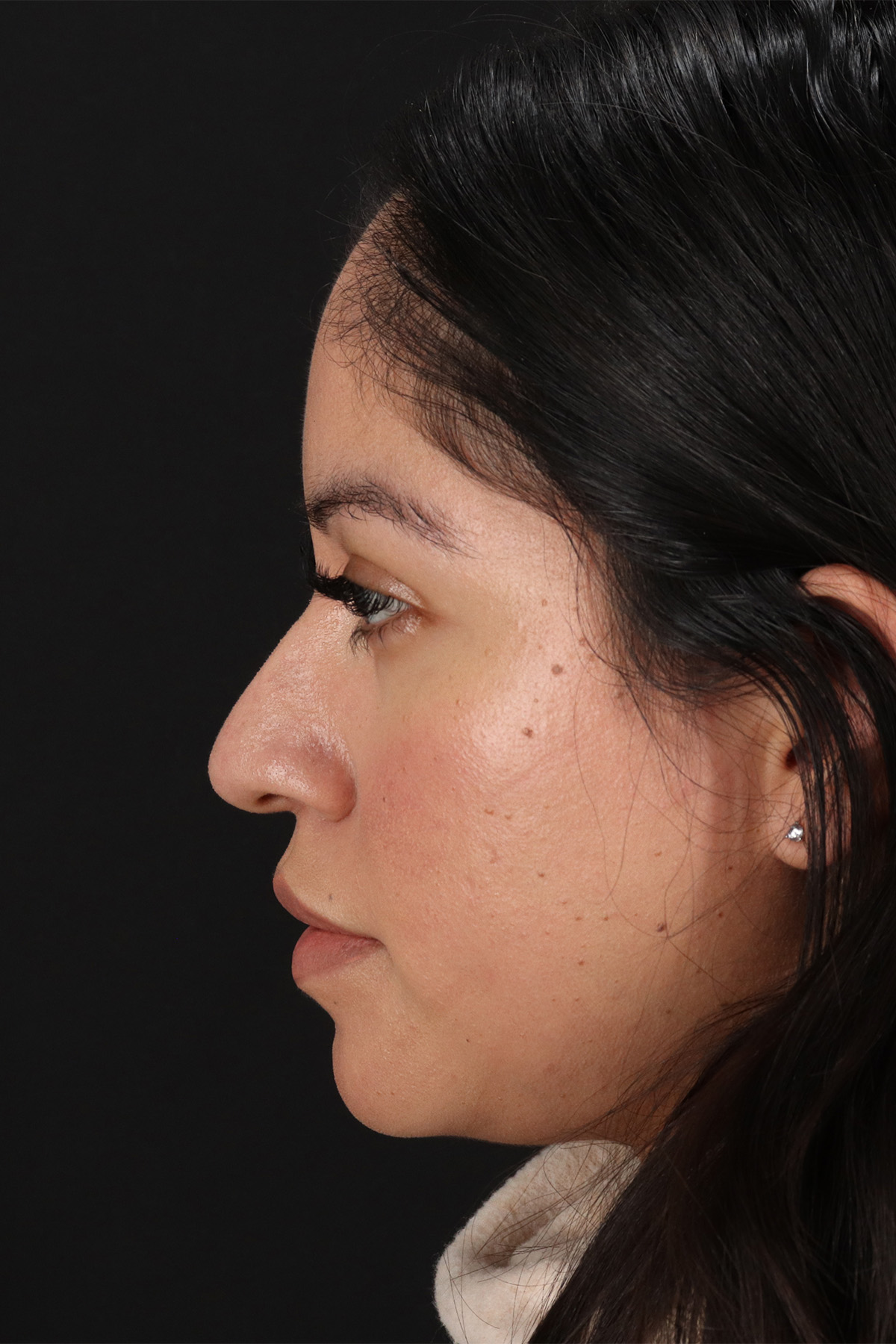 Liquid Rhinoplasty Before & After Patient #2290