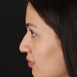 Rhinoplasty Before & After Patient #3236
