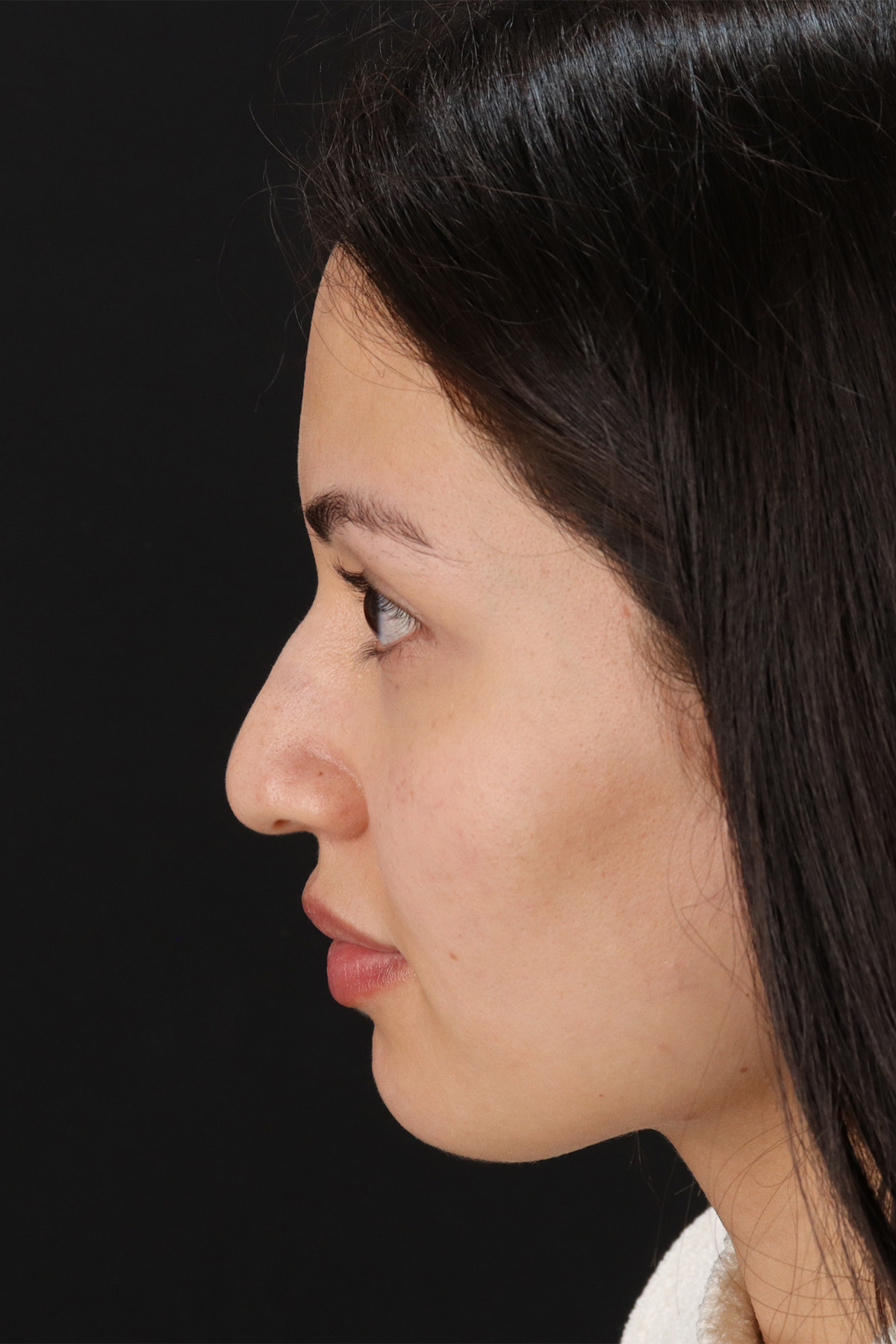 Rhinoplasty Before & After Patient #3236