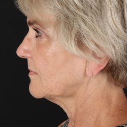 Facelift Before & After Patient #1943