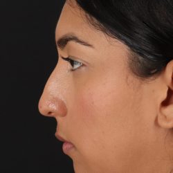 Liquid Rhinoplasty Before & After Patient #2232