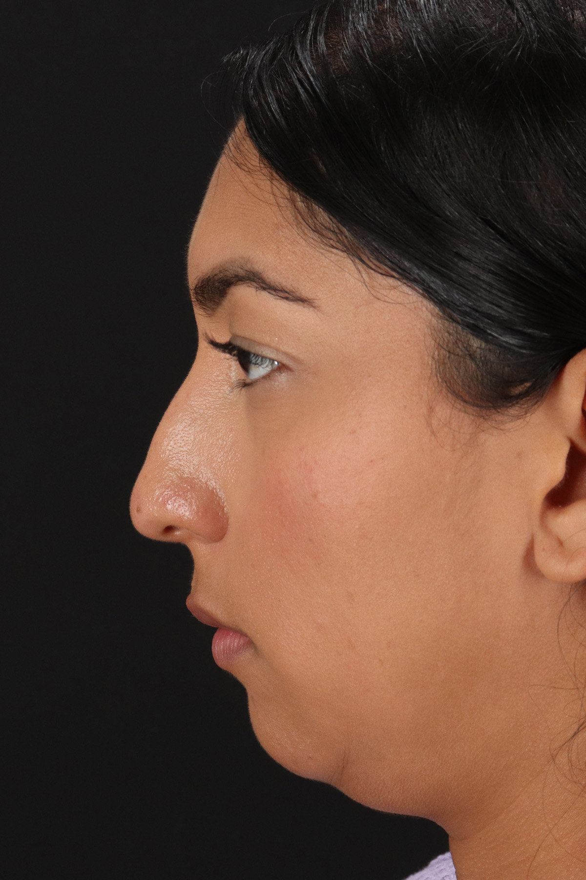 Liquid Rhinoplasty Before & After Patient #2232