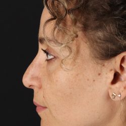 Liquid Rhinoplasty Before & After Patient #2276