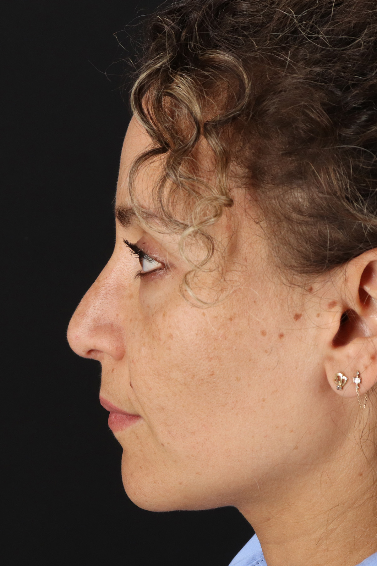 Liquid Rhinoplasty Before & After Patient #2276