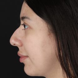Rhinoplasty Before & After Patient #3159