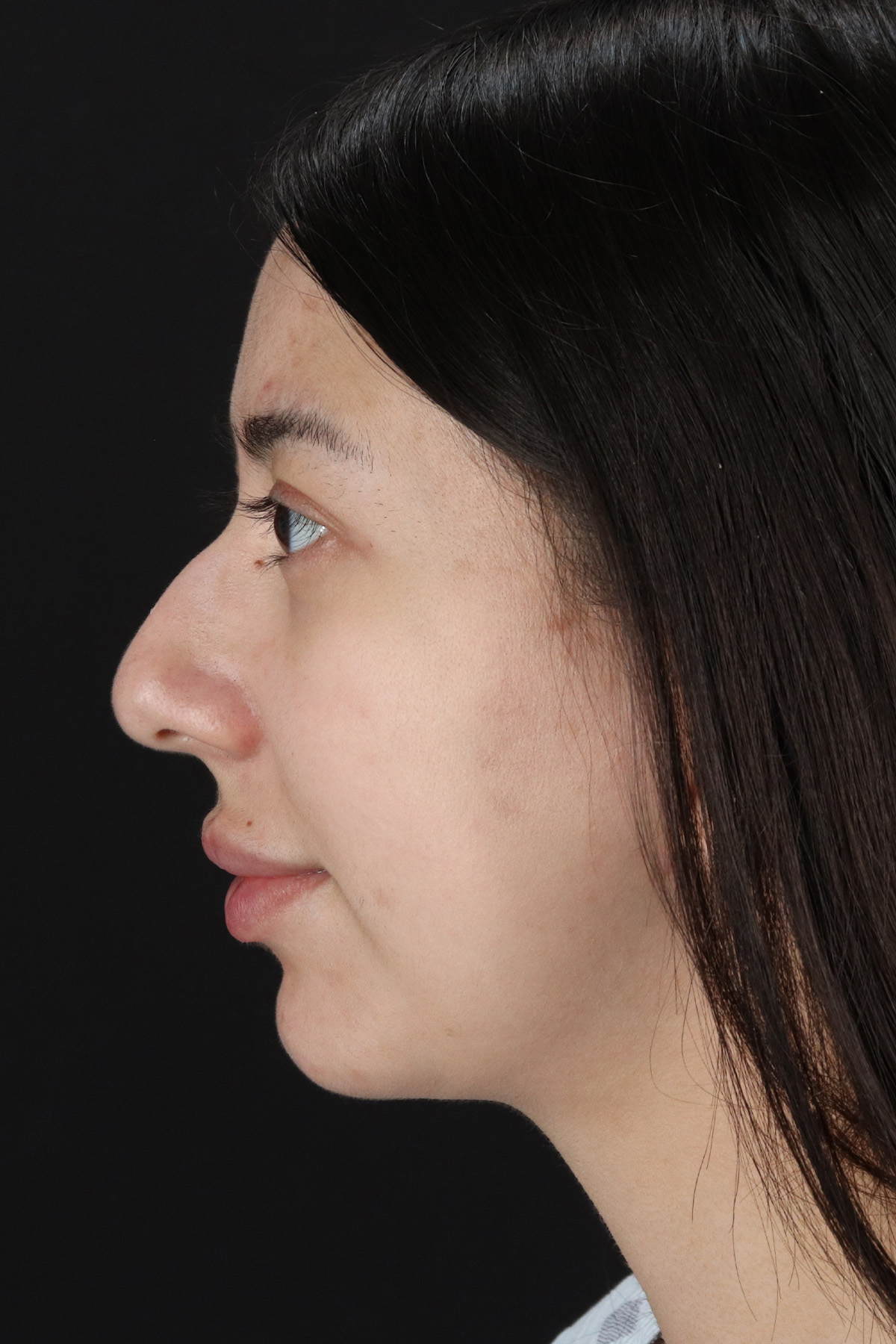 Rhinoplasty Before & After Patient #3159