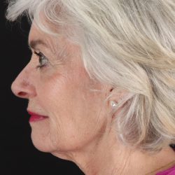 Upper Blepharoplasty Before & After Patient #5377