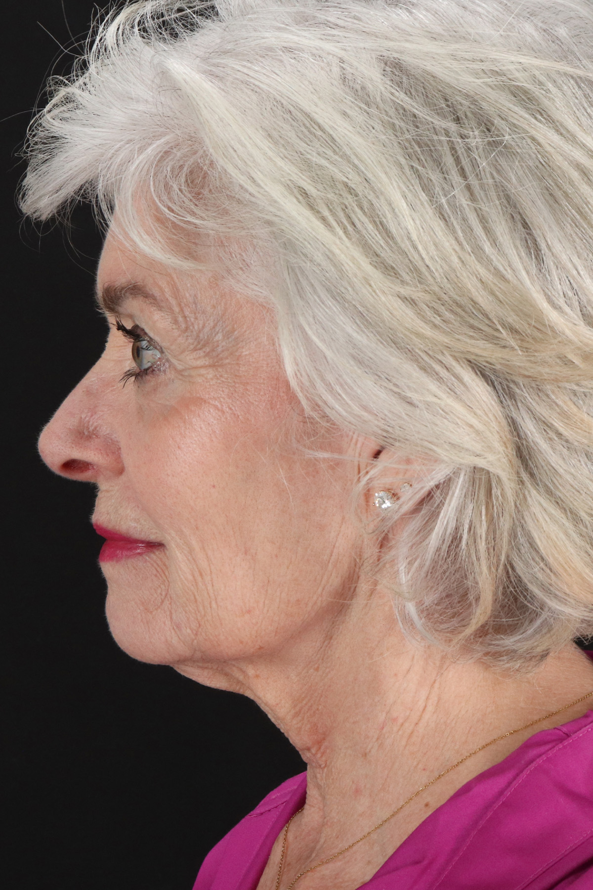 Upper Blepharoplasty Before & After Patient #5377