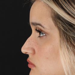 Rhinoplasty Before & After Patient #3258