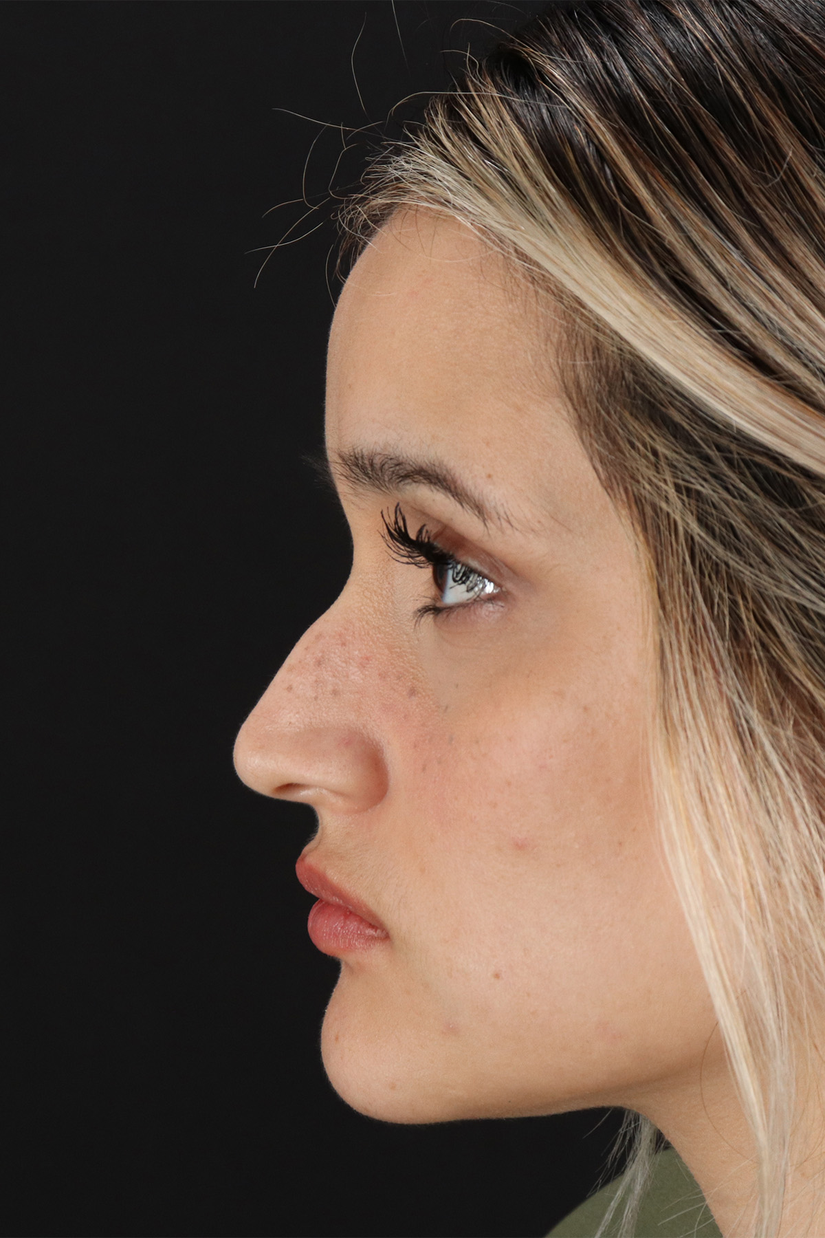 Rhinoplasty Before & After Patient #3258