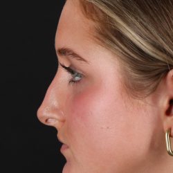 Liquid Rhinoplasty Before & After Patient #2221