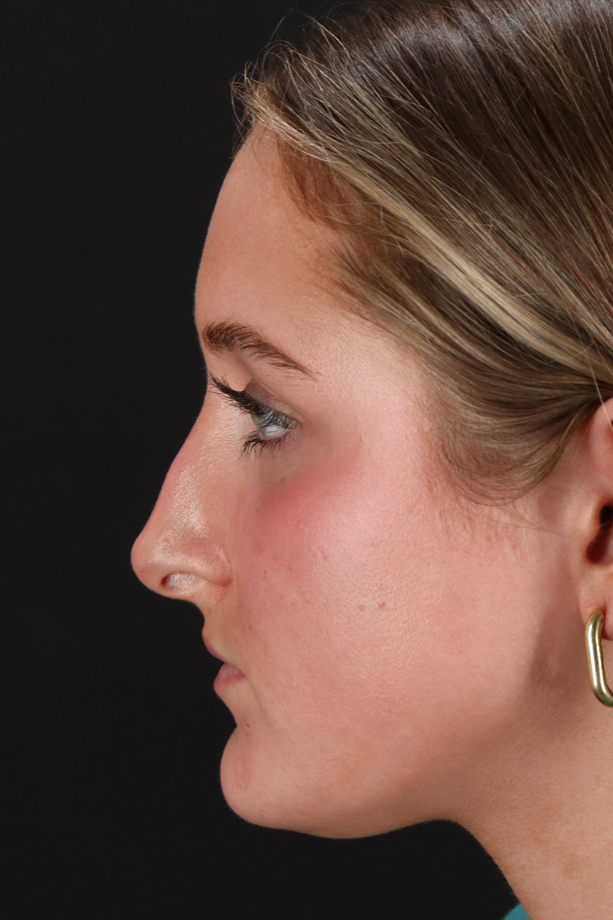 Liquid Rhinoplasty Before & After Patient #2221