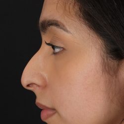 Chin Implant Before & After Patient #1637