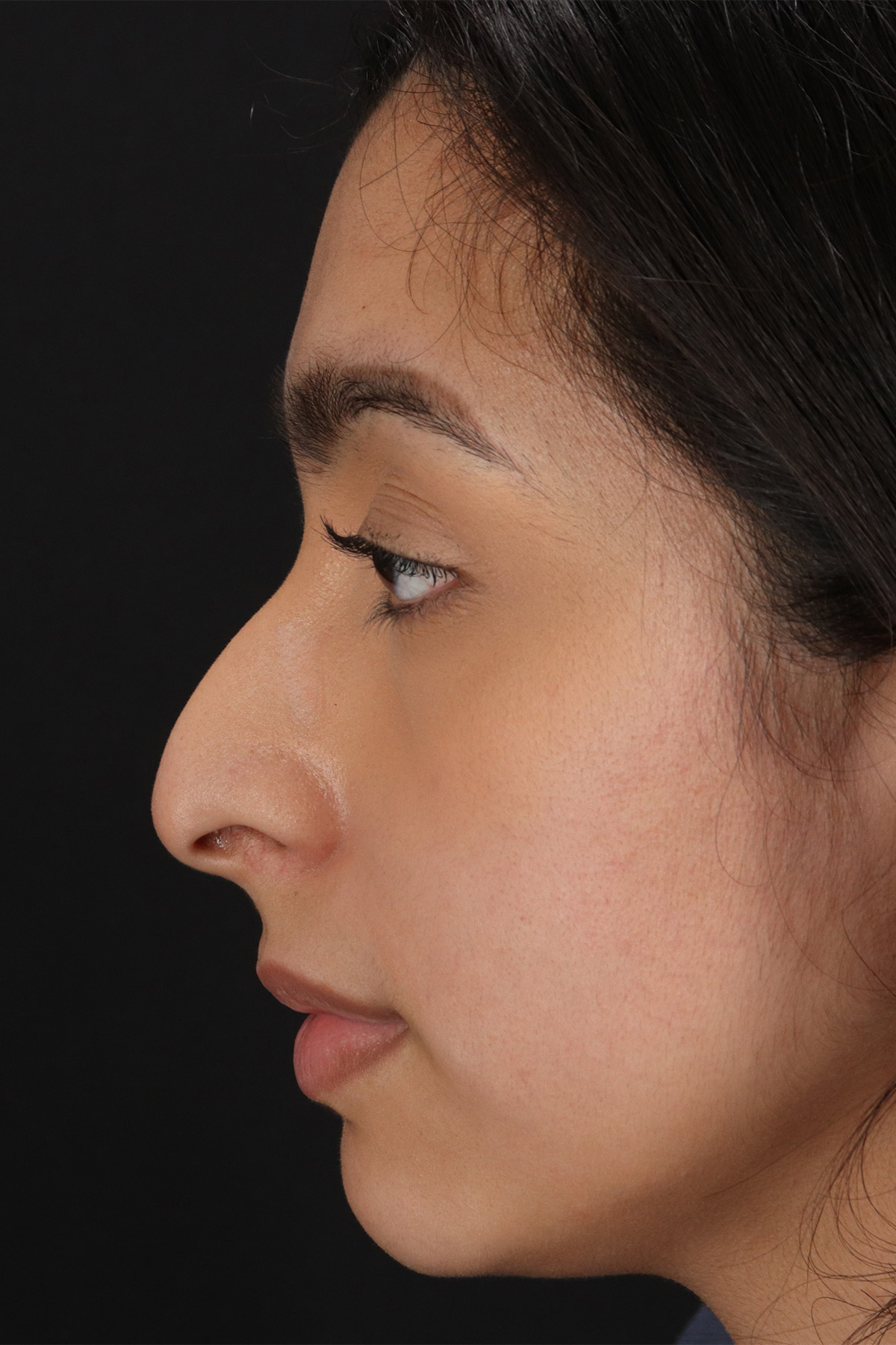 Chin Implant Before & After Patient #1637