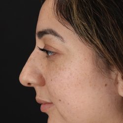 Rhinoplasty Before & After Patient #3115
