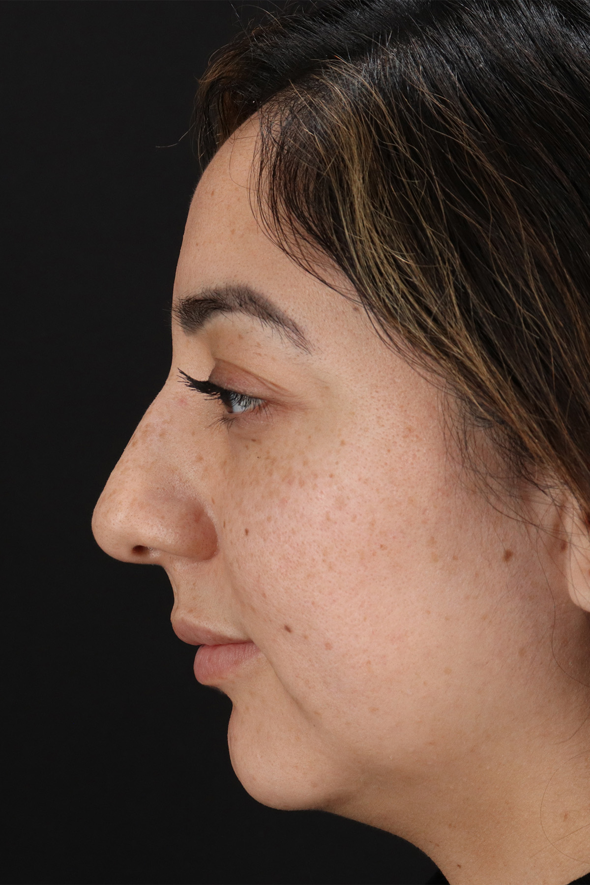 Rhinoplasty Before & After Patient #3115
