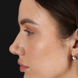 Rhinoplasty Before & After Patient #3137