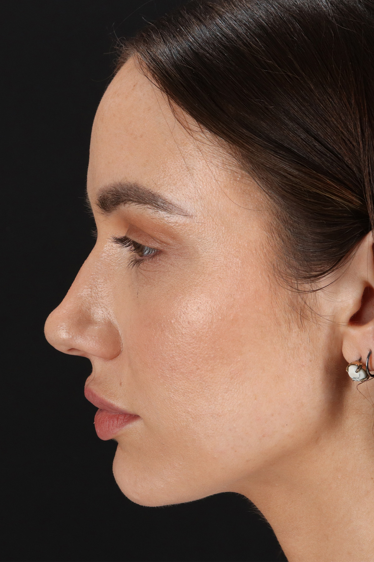 Rhinoplasty Before & After Patient #3137