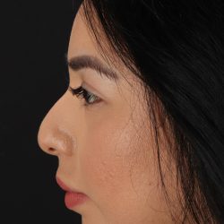 Chin Implant Before & After Patient #1626