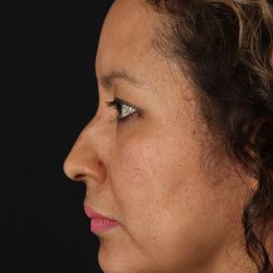 Rhinoplasty Before & After Patient #3225