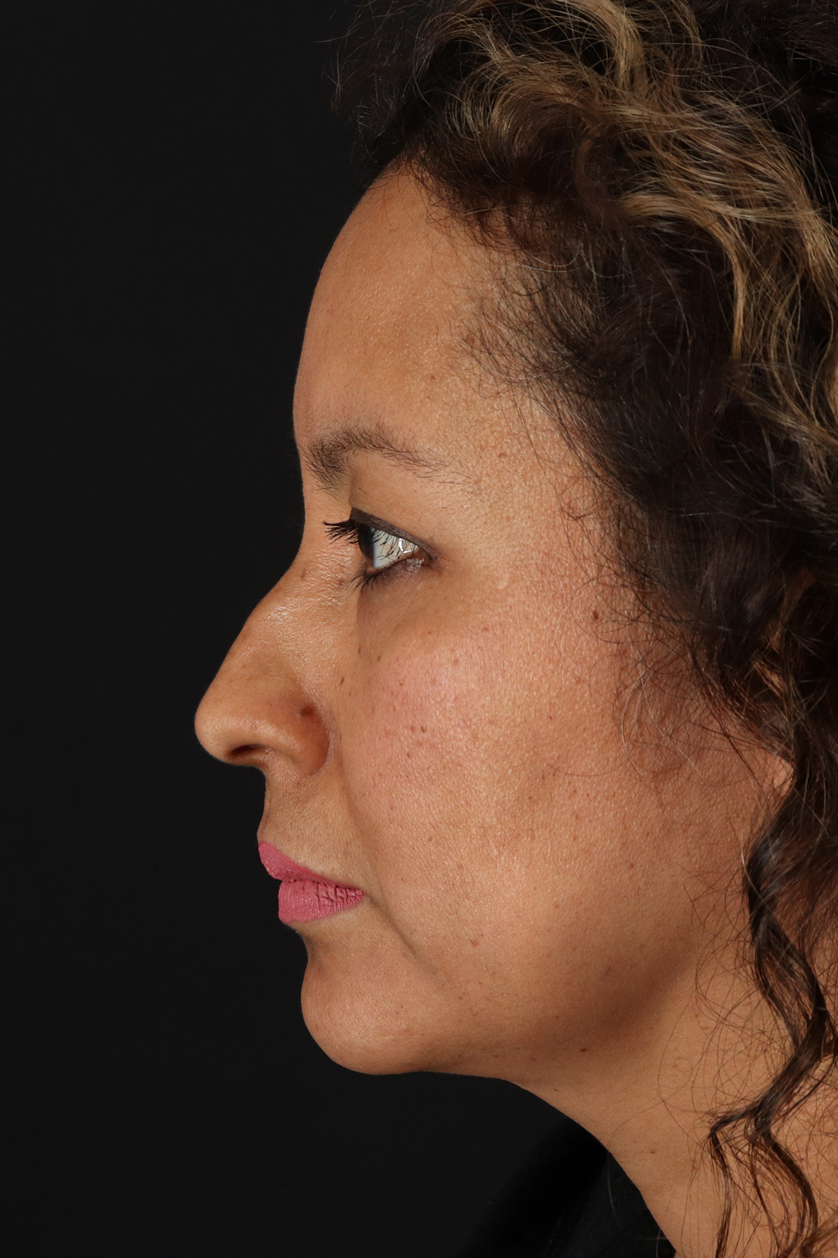 Rhinoplasty Before & After Patient #3225