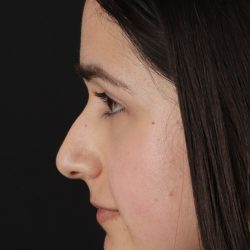 Liquid Rhinoplasty Before & After Patient #2188