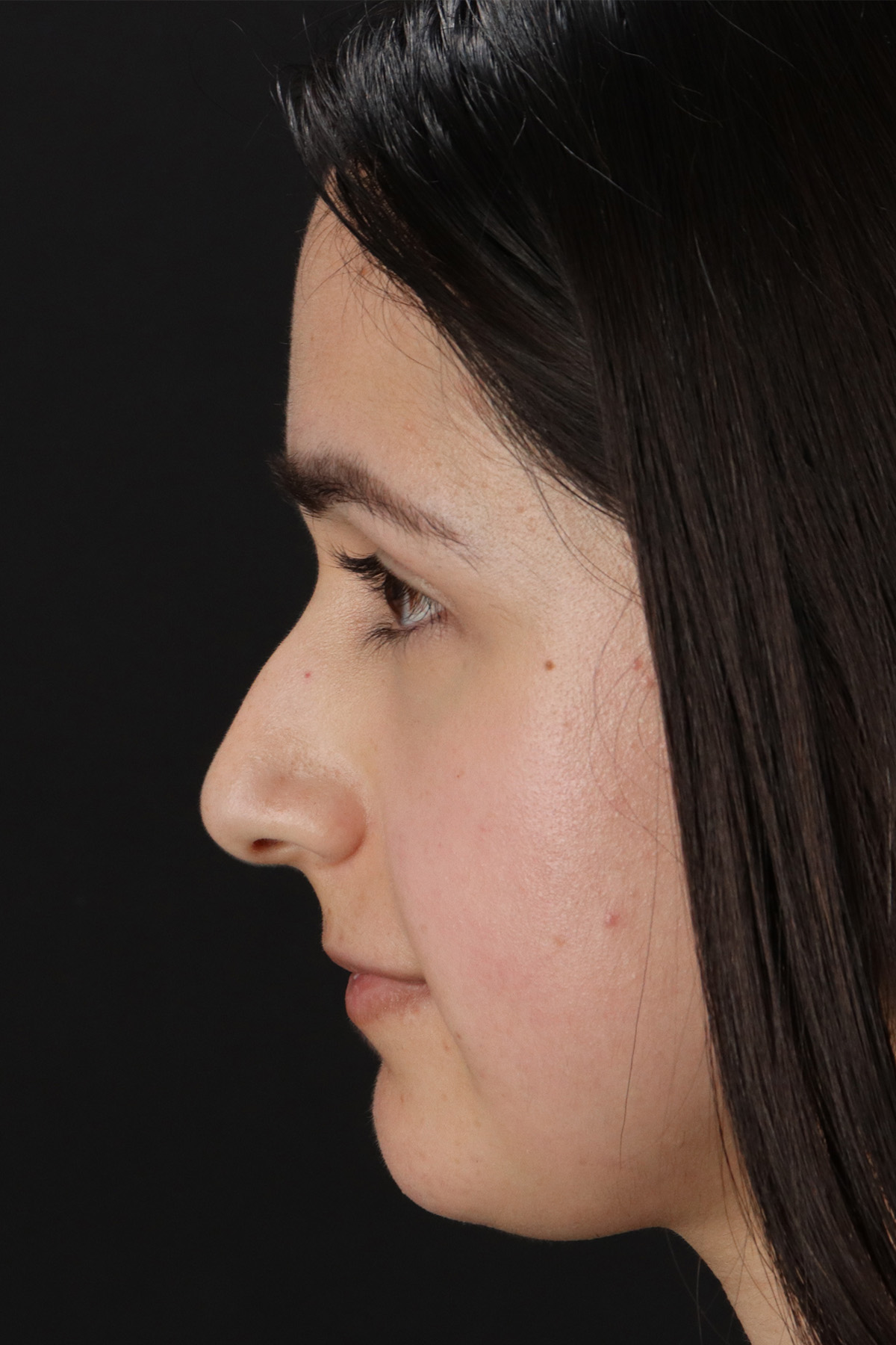 Liquid Rhinoplasty Before & After Patient #2188