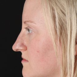 Rhinoplasty Before & After Patient #3126