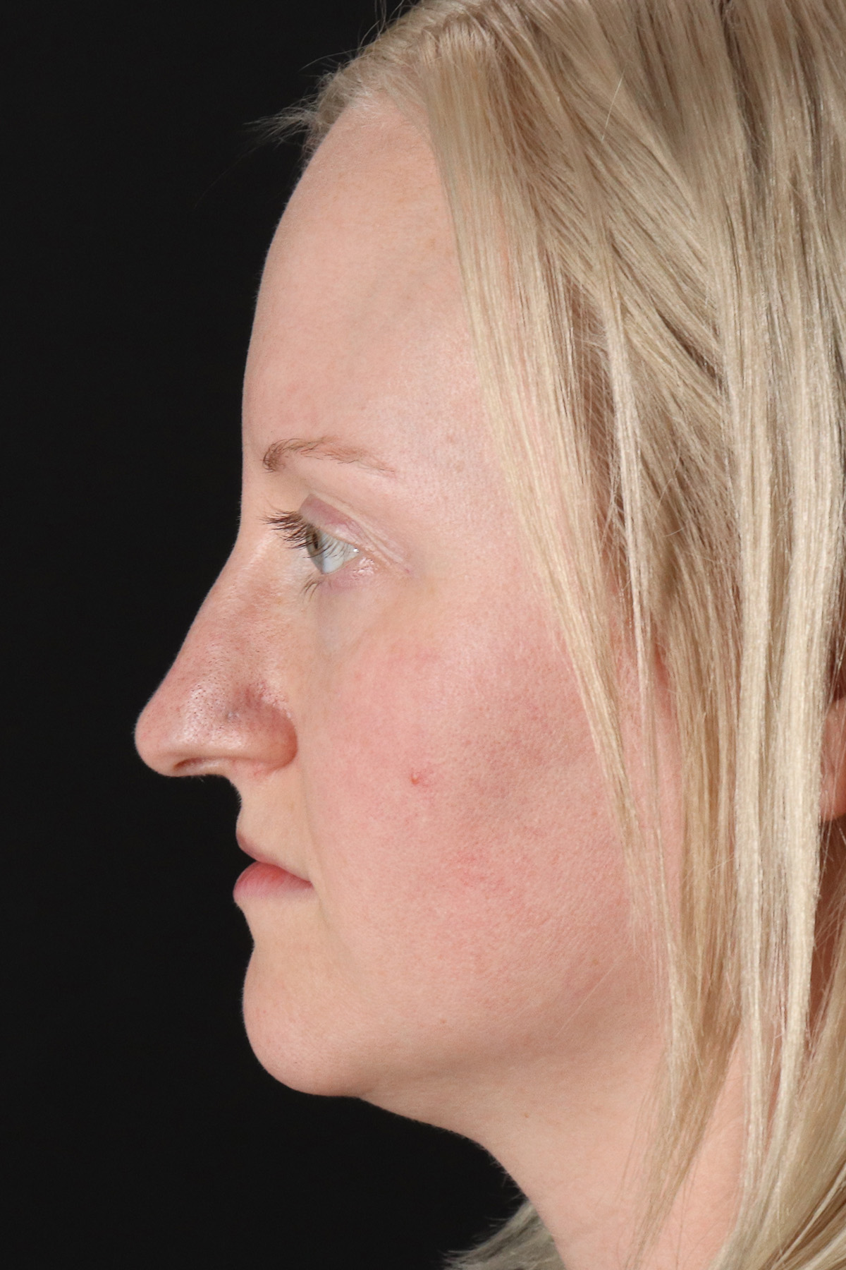 Rhinoplasty Before & After Patient #3126