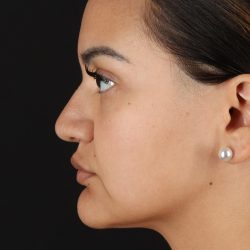 Rhinoplasty Before & After Patient #3192