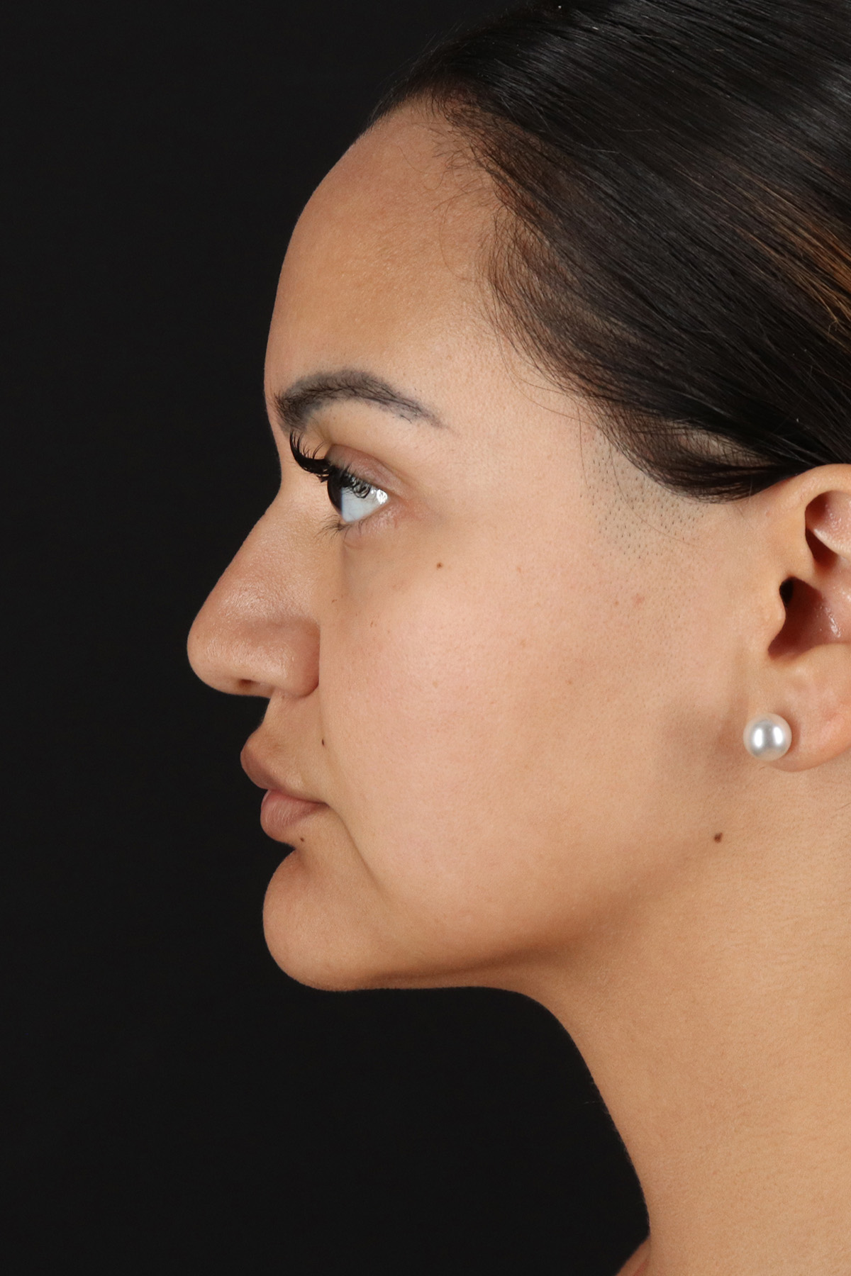 Rhinoplasty Before & After Patient #3192
