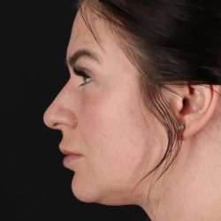 Rhinoplasty Before & After Patient #3093