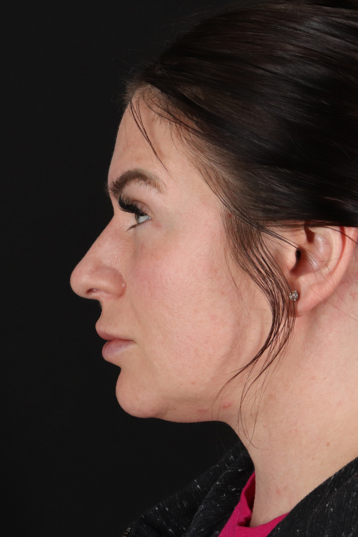 Rhinoplasty Before & After Patient #3093