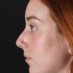 Rhinoplasty Before & After Patient #3170
