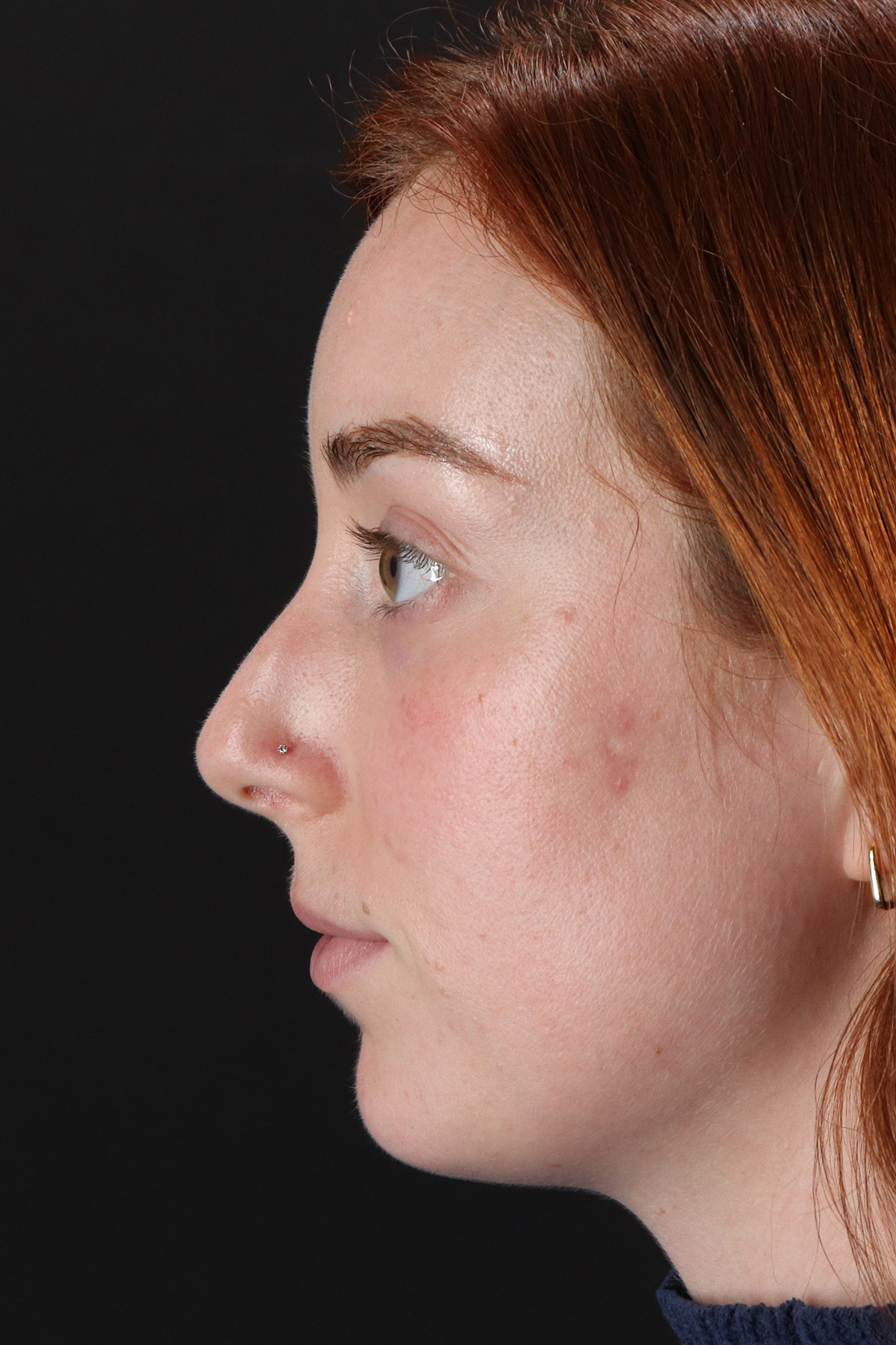 Rhinoplasty Before & After Patient #3170
