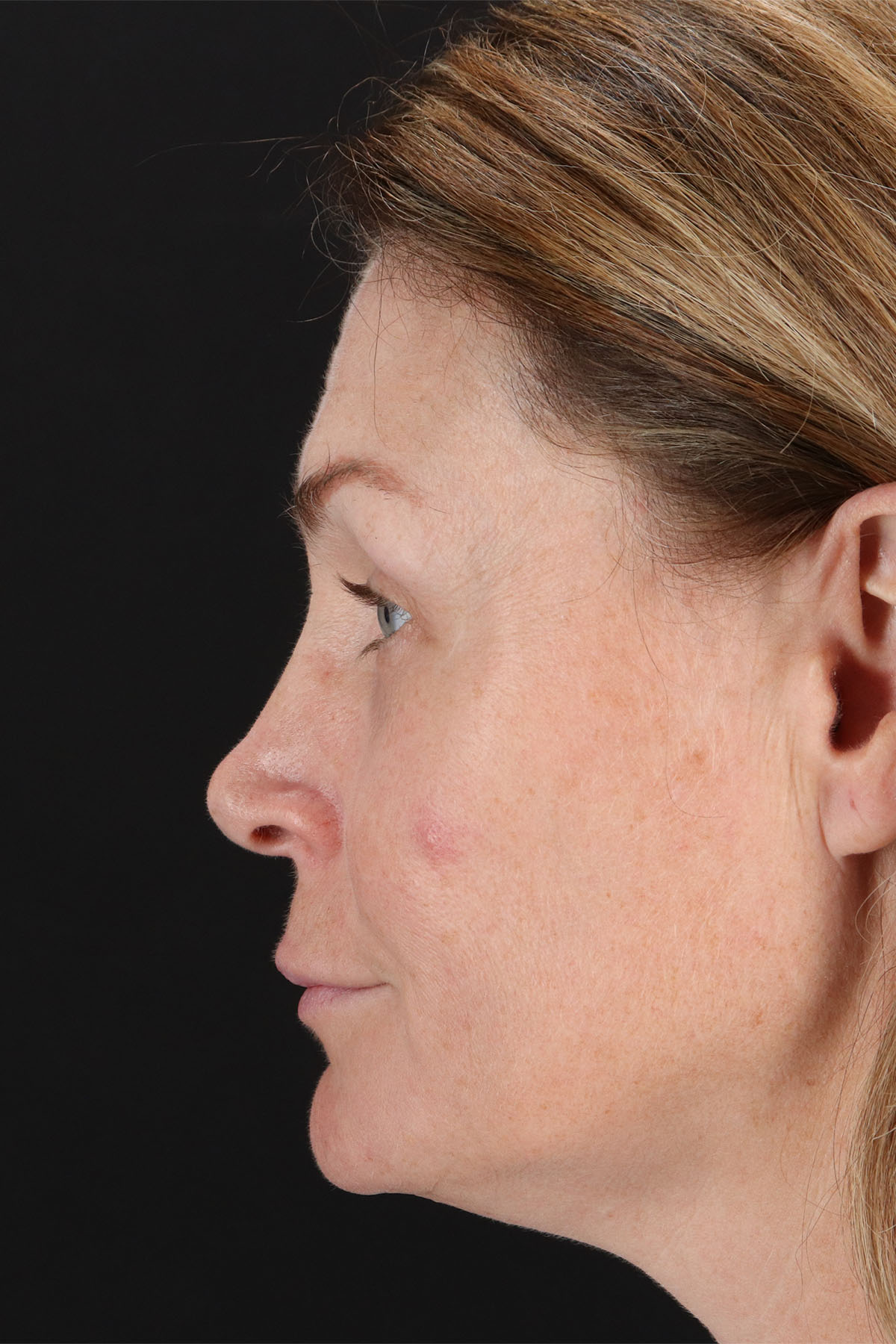 Lip Lift Before & After Patient #2144