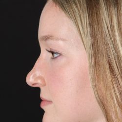 Liquid Rhinoplasty Before & After Patient #2177