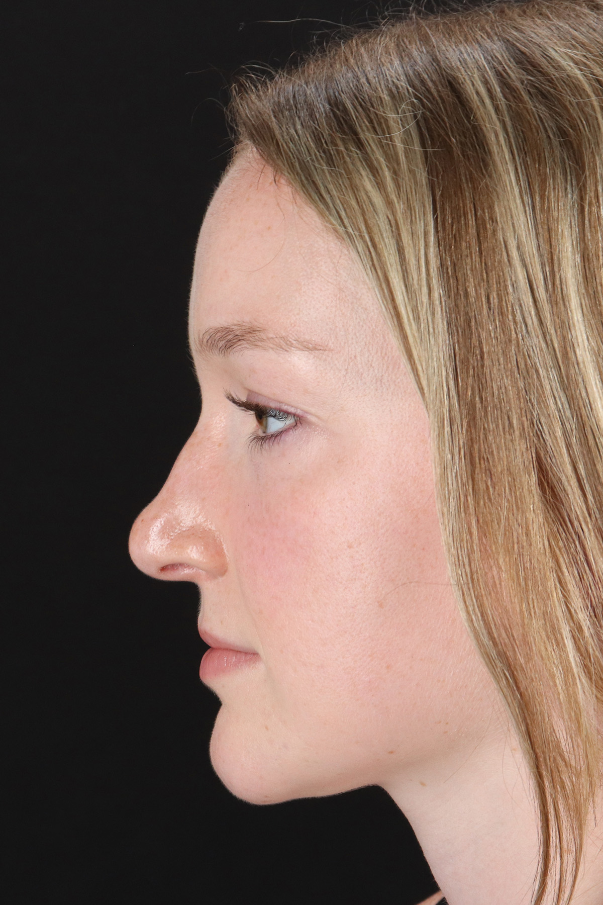 Liquid Rhinoplasty Before & After Patient #2177