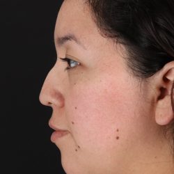 Rhinoplasty Before & After Patient #3060