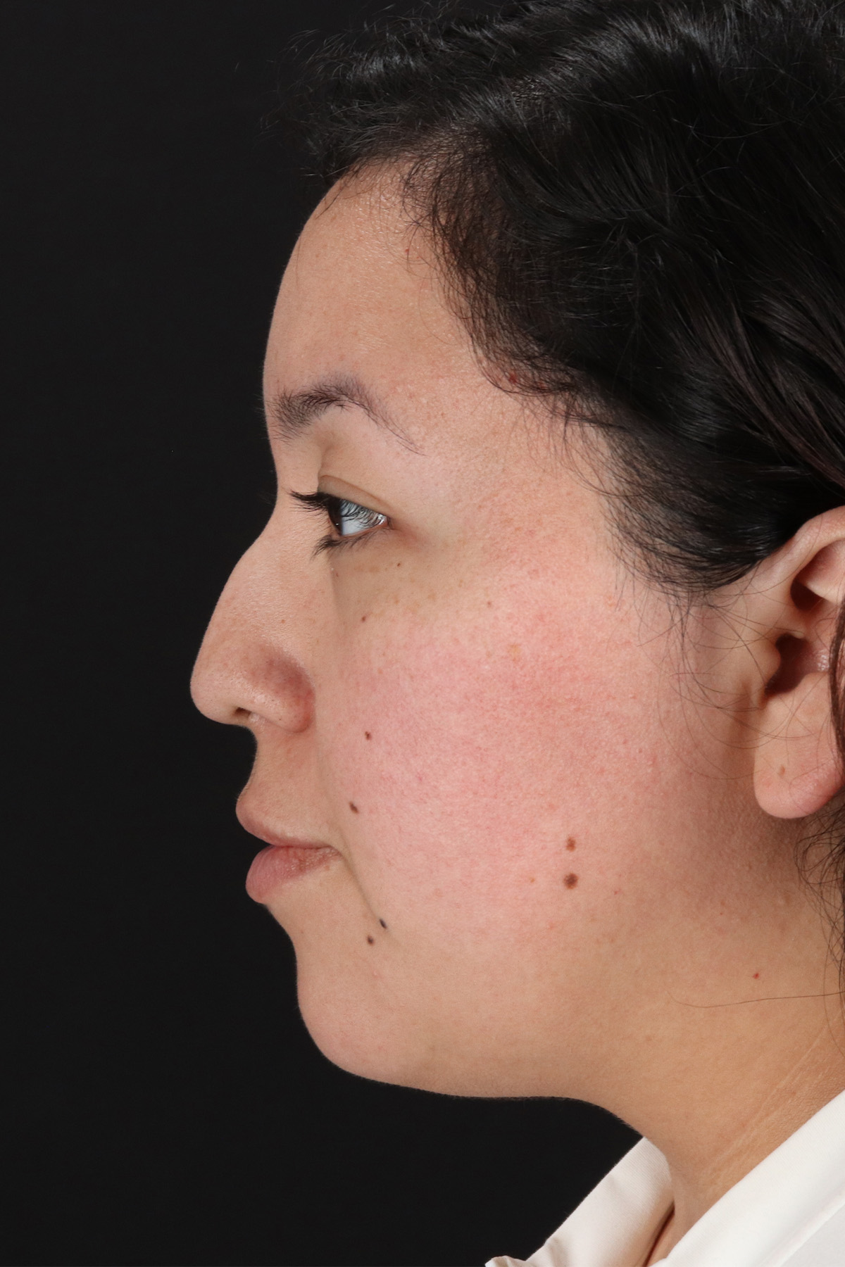 Rhinoplasty Before & After Patient #3060