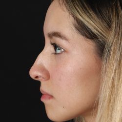 Rhinoplasty Before & After Patient #3302