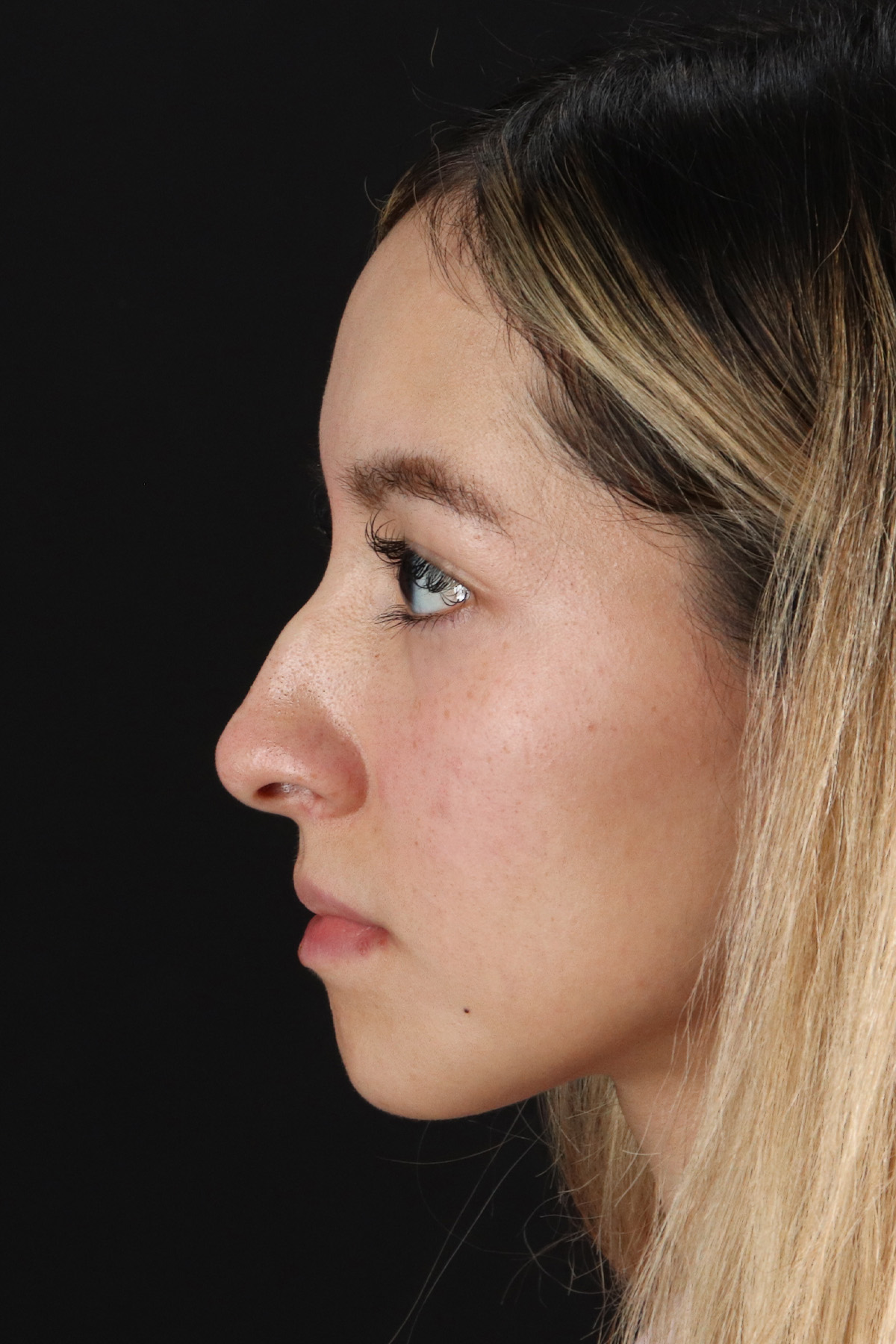 Rhinoplasty Before & After Patient #3302