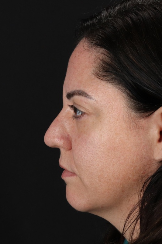 Browlift Before & After Patient #1363