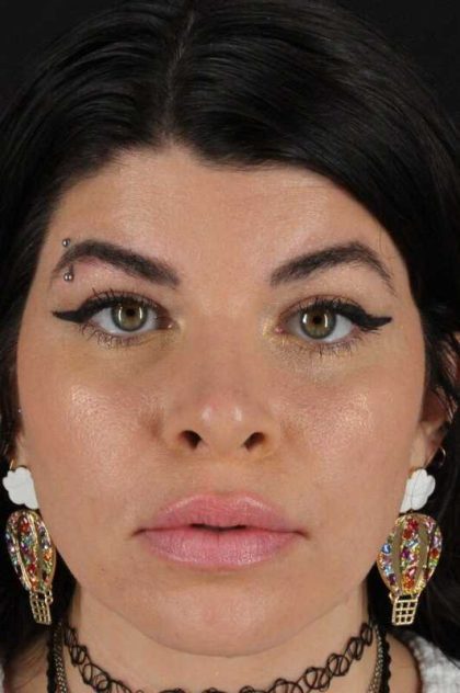Browlift Before & After Patient #1220