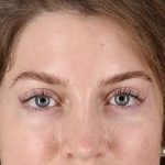 Browlift Before & After Patient #1319