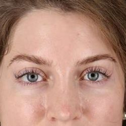 Browlift Before & After Patient #1319