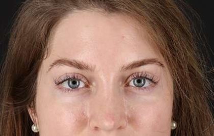 Browlift Before & After Patient #1319