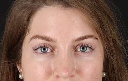 Browlift Before & After Patient #1319