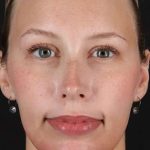 Fillers Before & After Patient #2030