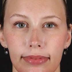 Fillers Before & After Patient #2030